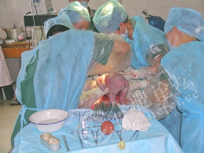 解剖孕妇大肚子 婴儿图片